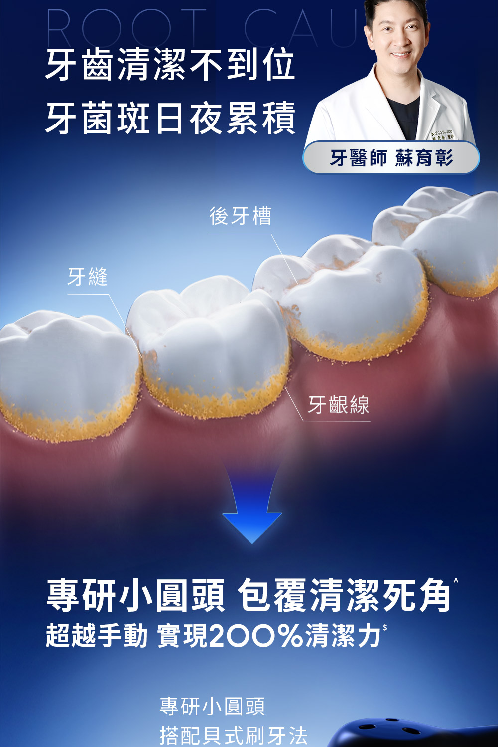 ROOT CAU牙齒清潔不到位牙菌斑日夜累積牙醫師 蘇育彰後牙槽牙縫牙齦線專研小圓頭 包覆清潔死角超越手動 實現%清潔力專研小圓頭搭配貝式刷牙法