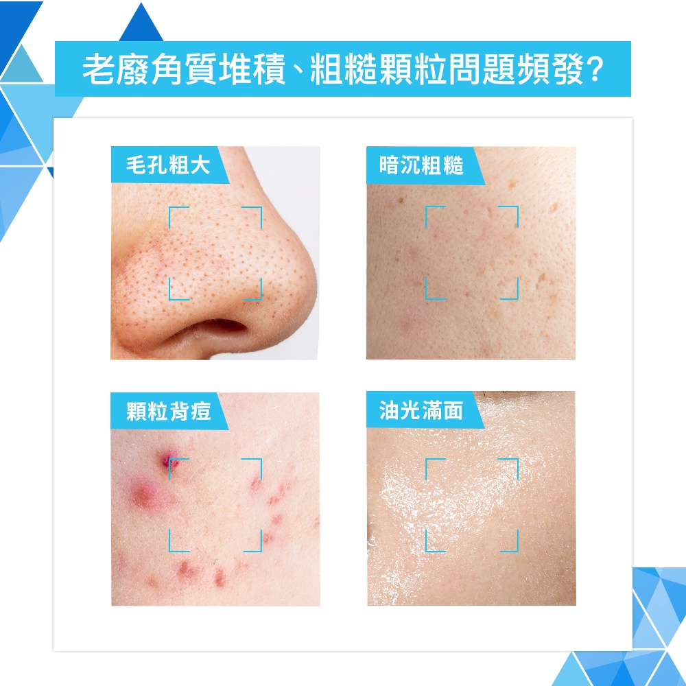 老廢角質堆積、粗糙顆粒問題頻發 毛孔粗大 暗沉粗糙 顆粒背痘 油光滿面 