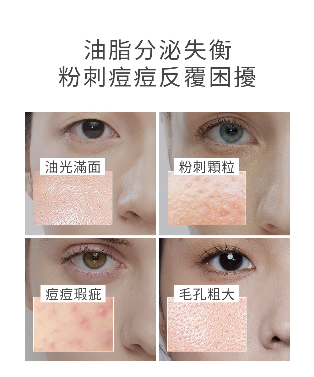粉刺痘痘反覆困擾